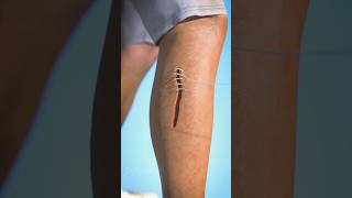 How stitches works||human wounds#viral#trending