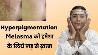 Magical Remedy for Hyperpigmentation Melasma | Pigmentation treatment at Home | Dr. Upasana Vohra