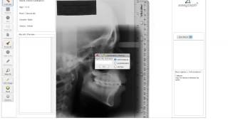 Calibration with an X-Ray Photo plus Ruler