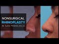 Non Surgical Rhinoplasty (