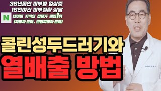 4K)콜린성두드러기 치료방법은? 콜린성두드러기와 운동? 콜린성두드러기와 반신욕?