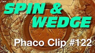 Phaco Clip #122 - SPIN \u0026 WEDGE