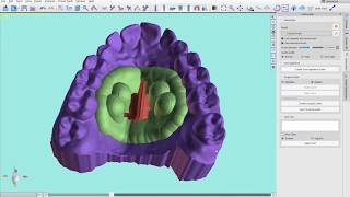U-Penn Skeletal Expander: Appliance Design