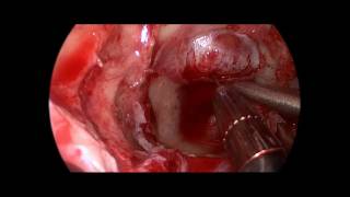 Endoscopic Endonasal Pituitary Macroadenoma Surgery - Updated Version Available