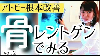 【アトピー根本改善②】｢骨｣をレントゲンでみる！ステロイド性骨粗鬆症が改善した！【アトピー研究34年】