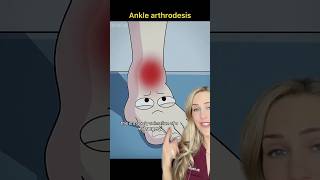 Doctor explains: ankle fusion surgery