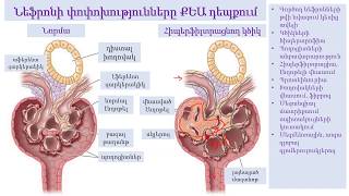 Chronic kidney disease - case discussion (Armenian)