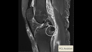 PCL Avulsion