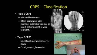 Complex Regional Pain Syndrome (CRPS) - Dr Apel 2/5/2023