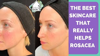 Rosacea skincare treatment that REALLY works