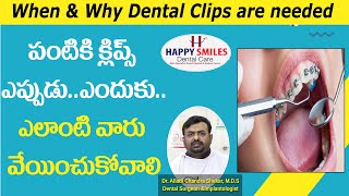 పంటికి క్లిప్స్ ఏ వయసులో వేయించుకోవాలి ||  How do you know if you need braces..? ||