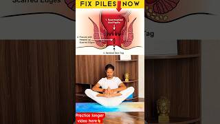 Fix Piles \u0026 Fissures Now🔥 #pilesrelief #fissure