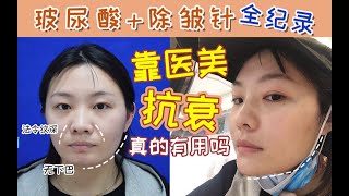 法令纹太 显 老 啦！20岁女孩像30！如何消除鱼尾纹+鼻基底凹陷【初老少女的除皱vlog】