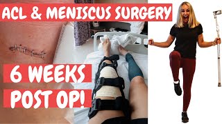 ACL & MENISCUS SURGERY | 6 WEEKS POST OP | acl rehab |