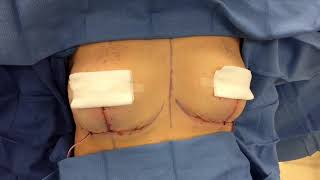 Breast Lift Before and After - Dr Anthony Youn