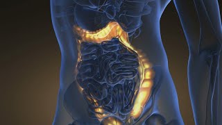 Healthy SA: Keeping away the preventable colorectal cancer