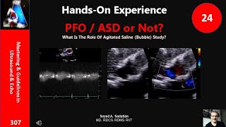 Hands-On Experience 24: PFO / ASD or Not? Role of Bubble test