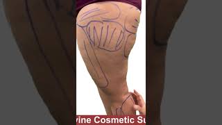 Thigh Liposuction along with Buttock Reshaping