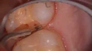 Hemostasis with Photon Laser by Dr. Glenn A. van As