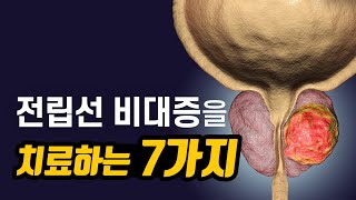 대부분 거꾸로 하고 있는 전립선 비대증 치료