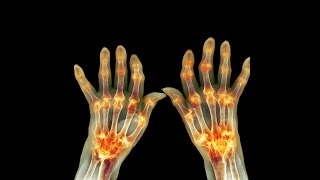 Understanding Rheumatoid Arthritis: Diagnosis & Management