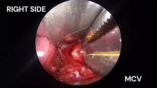 Bilateral submandibular calculus - removal by combined approach