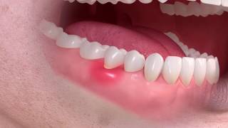 Gum disease (periodontitis)