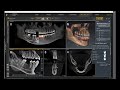 Sicat Implant: Prepare Data – Tracing the Nerve