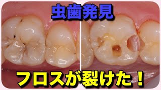 虫歯治療のわかりやすい説明［ノンメタルその２］定期検診で訪れた方。歯と歯の間に虫歯が見つかりました。デンタルフロスがひかかるのです。ノンメタル治療をしました。