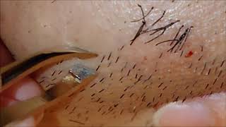 【Husband's hair removal】髭抜き動画/５０本チャレンジ