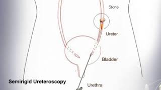 Ureteroscopy | Treatment of lower and middle ureteral stone #shorts #short #shortvideo #shortsvideo
