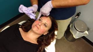 Introduction to Microneedling in Pittsburgh