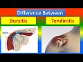 Difference Between Bursitis and Tendinitis