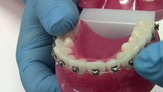 How to Remove a Coil Spring (Orthodontic emergency)