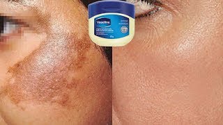 How To Use Vaseline To Remove Skin Pigmentation In Just 10 Days |  Home Remedies