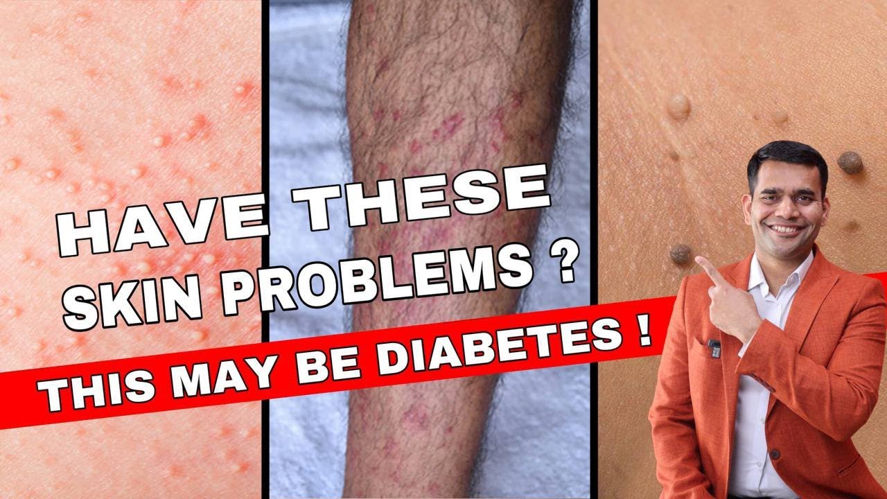 12 Skin Warning Signs Of Diabetes | Diabetes Skin Signs - YouTube