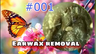 Very thick ear wax removal || Very difficult to removed-Blackhead