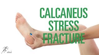 Calcaneus stress fracture: Signs, symptoms and treatment options