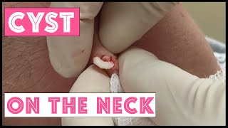 Small cyst on neck that is recurrent: Punch Removal