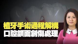 TVB News 植牙過程注意事項 口腔頜面治療處理 (最強生命線 黃靖婷 TVB News) bji 2.1