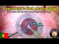 CataractCoach 1032: Portugal resident's first phaco chop surgery