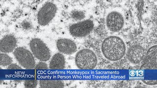 Officials Confirm Monkeypox Case In Sacramento County