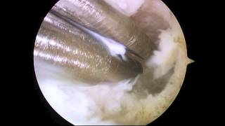 BTB ACL Reconstruction