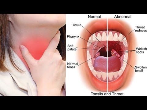 6 Best Home Remedies for Tonsillitis 6 Best Home Remedies for Tonsillitis