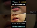 입술 흉터치료사례 전후비교｜피부재생치료 튼살치료. 흉터치료 여드름흉터 명옥헌 한의원