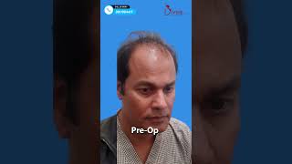 Long Hair Transplant Result After 3rd Day | Amazing Before After Result