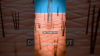 How Splinters Get Unstuck 😲 Surgeon Reacts