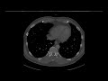 STR Cardiothoracic Case Webinar 4/11/2019