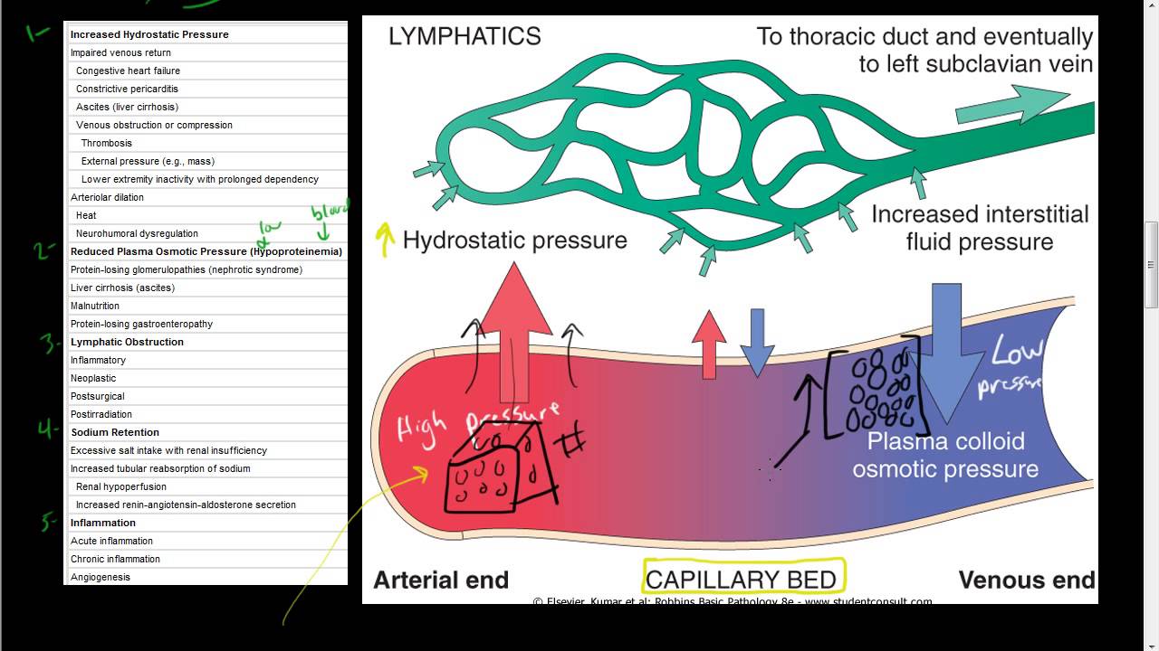 43 Hemodynamic Disorders Edema Lymphatics Disorders Lymphedema