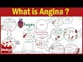 Pharmacology - What is Angina Pectoris ? Types of Angina, Symptoms, Causes &Treatment FROM A TO Z